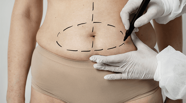 Abdominoplastía High Definition (Tummy tuck)
