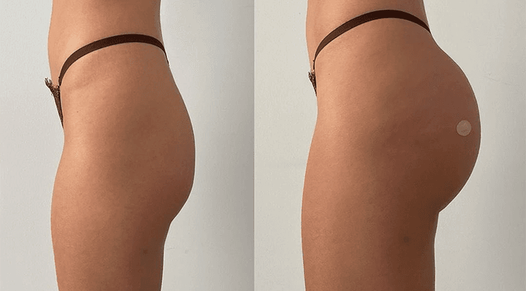 Aumento de glúteos (Lipotransferencia glútea)