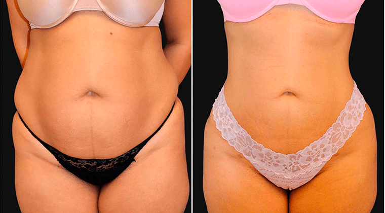 Lipo 360 BodyTite