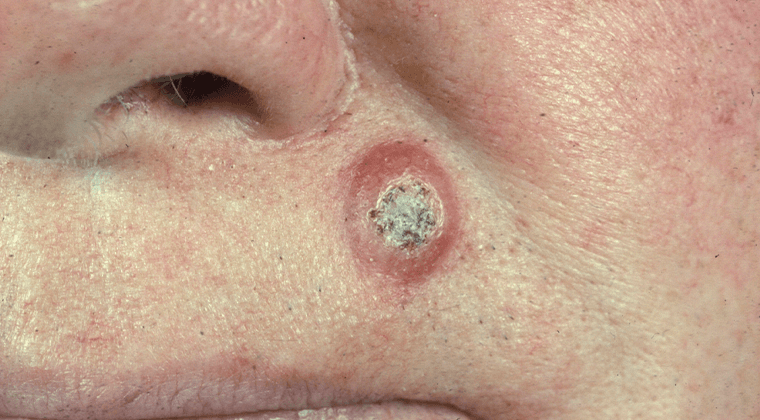 Cáncer facial