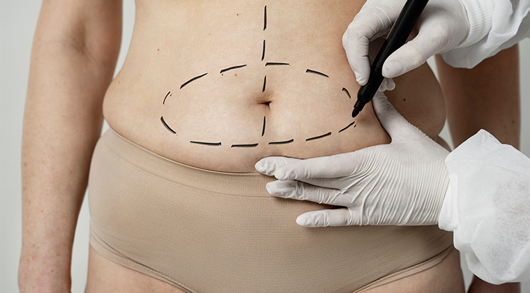 Abdominoplastía High Definition (Tummy tuck)